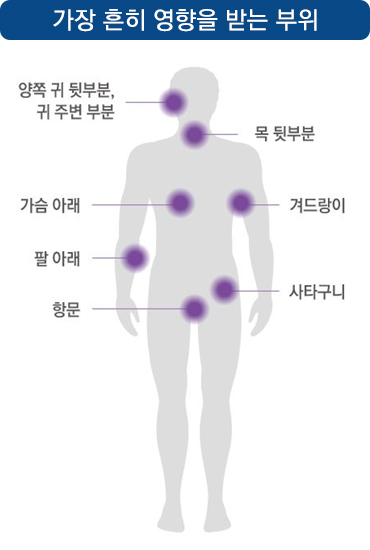 발생부위